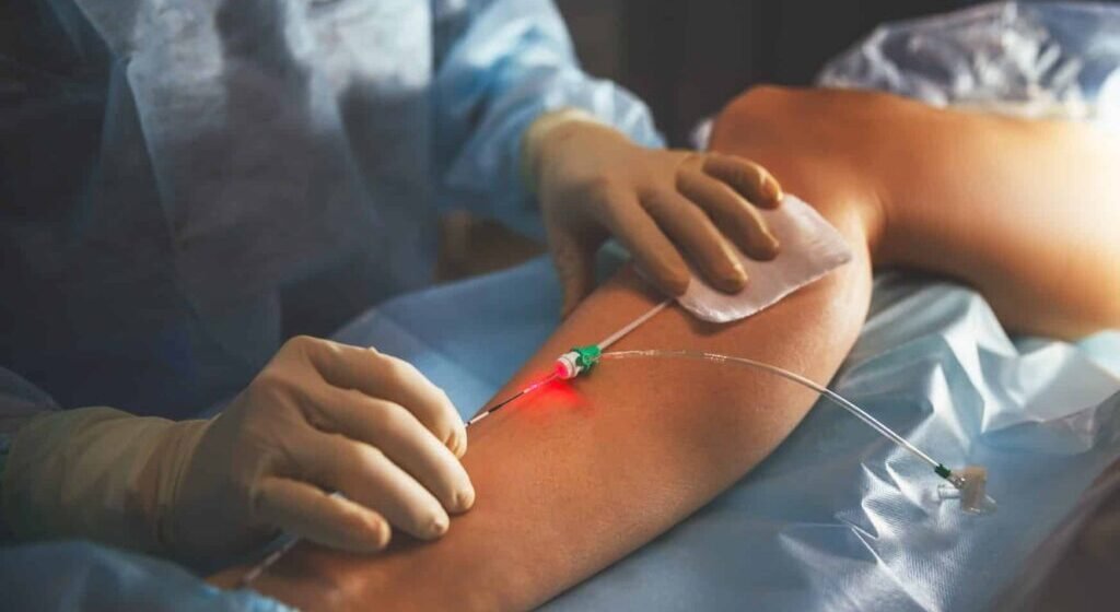Minimally Invasive Vein Treatments: The Best Solution to Varicose Veins in 2026