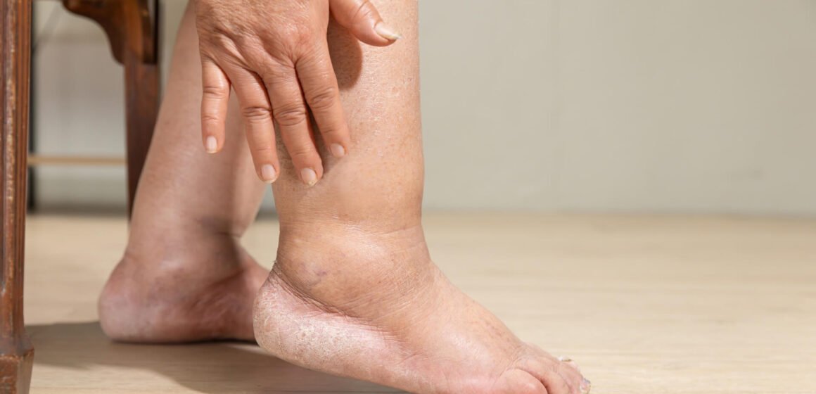Peripheral Artery Disease Peripheral Artery Disease Symptoms: Early Warning Signs You Should Never Ignore
