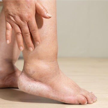 Peripheral Artery Disease Symptoms: Early Warning Signs You Should Never Ignore