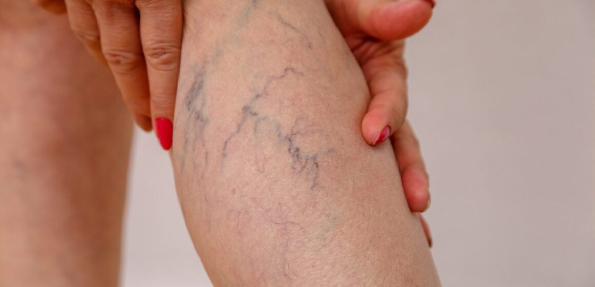 Phoenix Vein in Treatment – The Solution To Improved Circulation And Healthier Legs