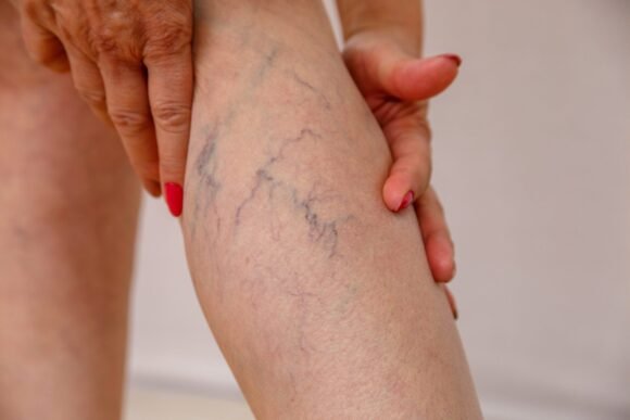 Phoenix Vein in Treatment Phoenix Vein in Treatment – The Solution To Improved Circulation And Healthier Legs
