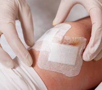 New Age Solutions for Advanced Wound Care in Phoenix Chronic Wounds