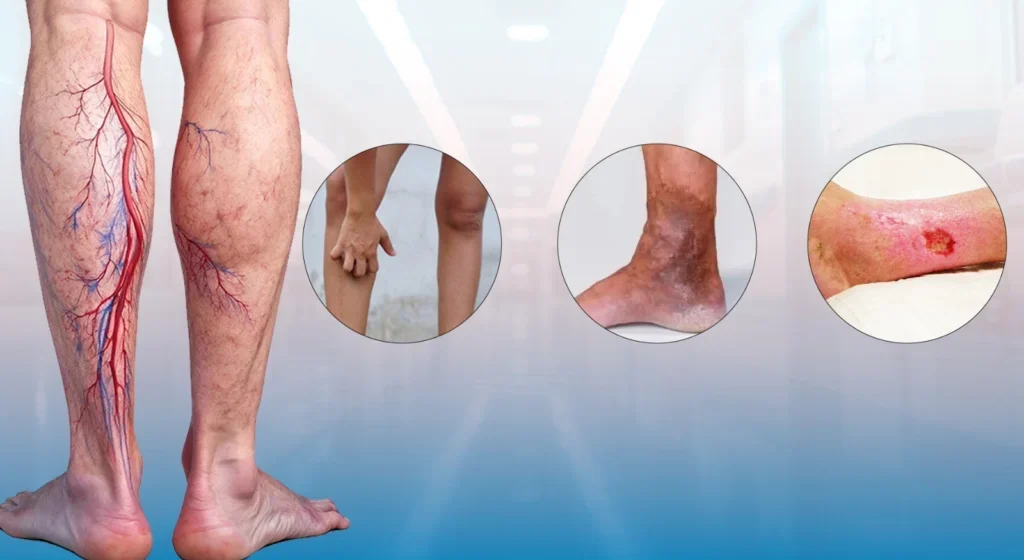 Why Do Varicose Veins Get Worse Over Time?