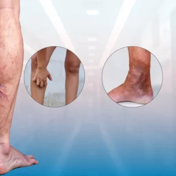 Why Do Varicose Veins Get Worse Over Time?