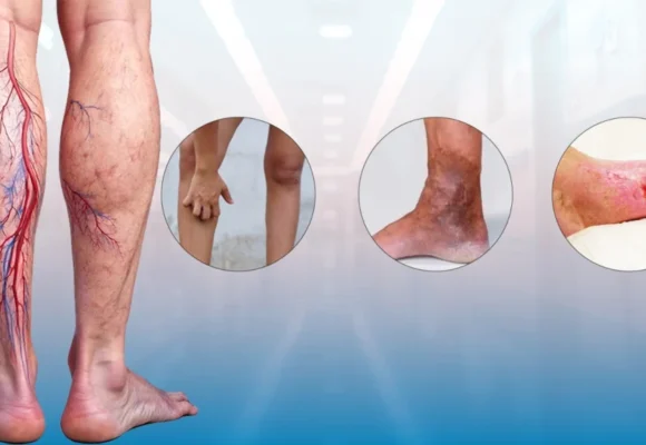 Are-Varicose-Veins-Dangerous-1024x576.jpeg Why Do Varicose Veins Get Worse Over Time?